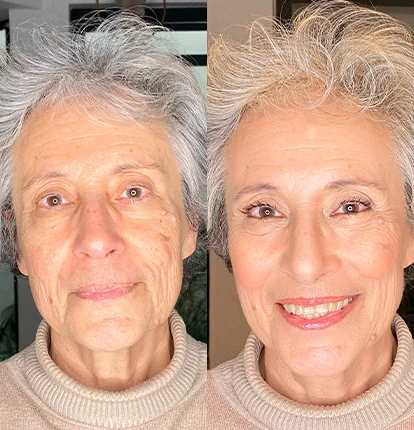 Antes e Depois 13