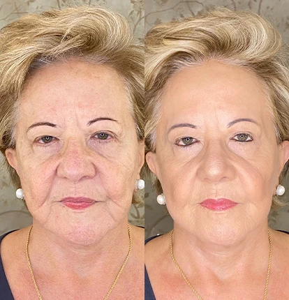 Antes e Depois 14